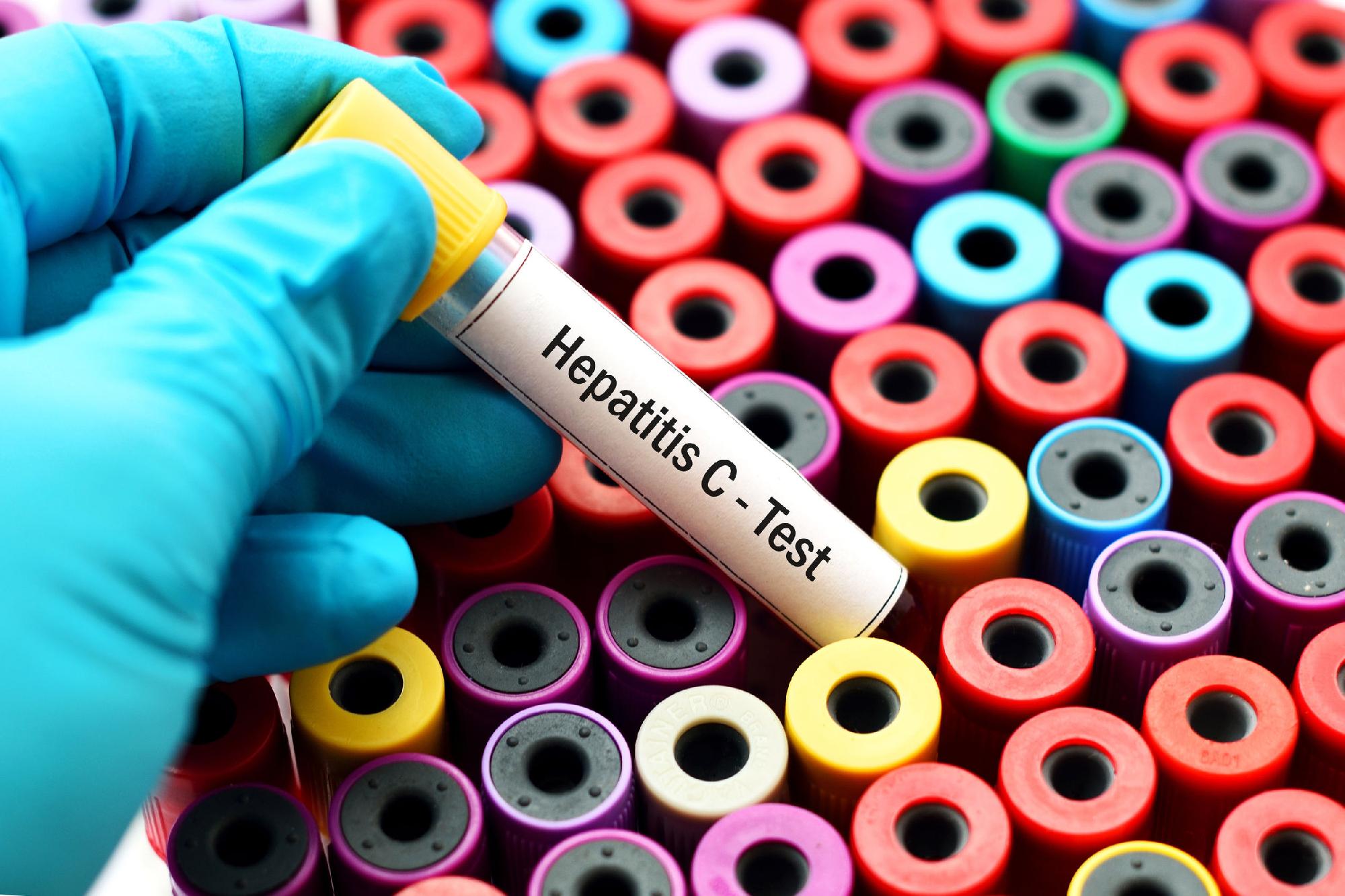Ingyenes hepatitis C-szűrés lesz az országban több helyen