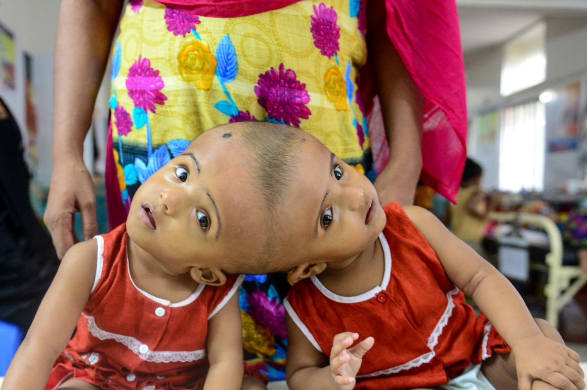 Sikeresen szétválasztották a fejüknél összenőtt bangladesi sziámi ikreket