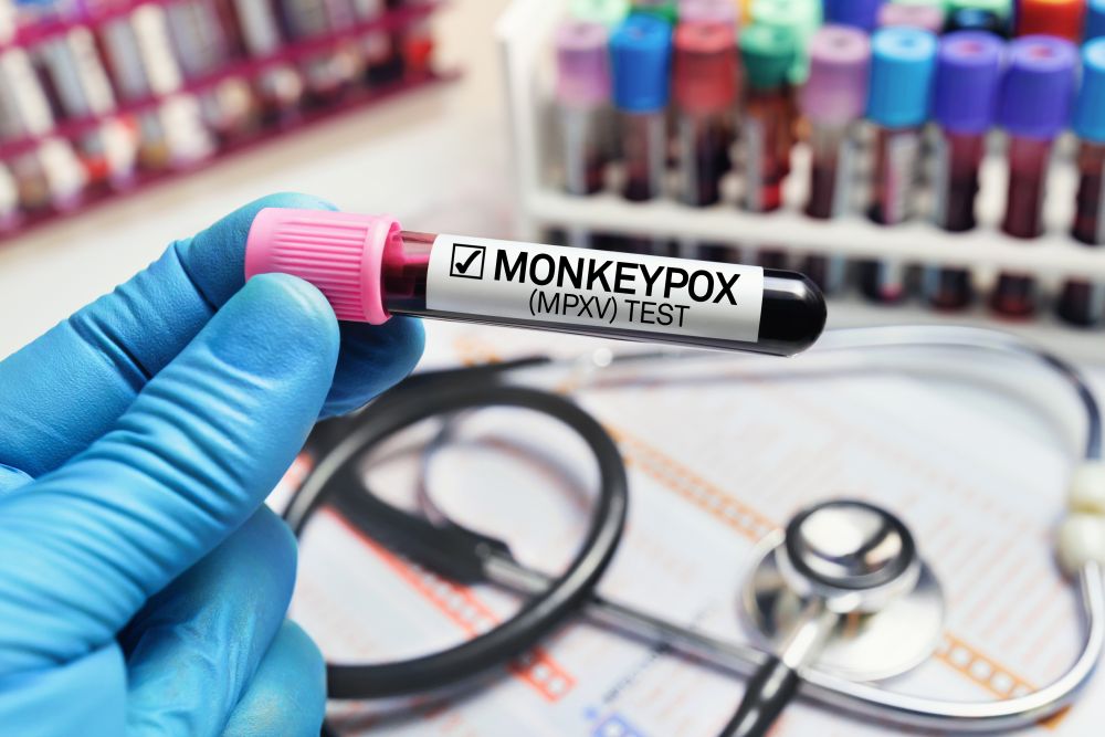 Szerbiában is regisztrálták az első majomhimlős fertőzöttet